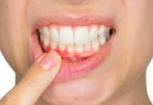 Get Your Gums Checked Before You Get Wrecked! Gum diseases